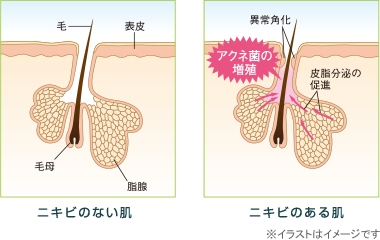 ニキビのない肌ニキビのある肌